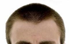 mature hairline and hair transplant