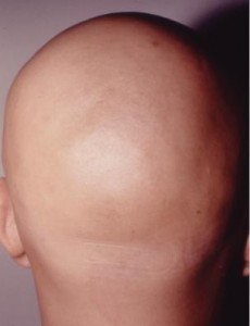 alopecia universalis