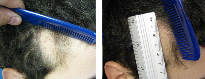 CTTA congenital temporal triangular alopecia