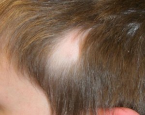 congenital temporal alopecia