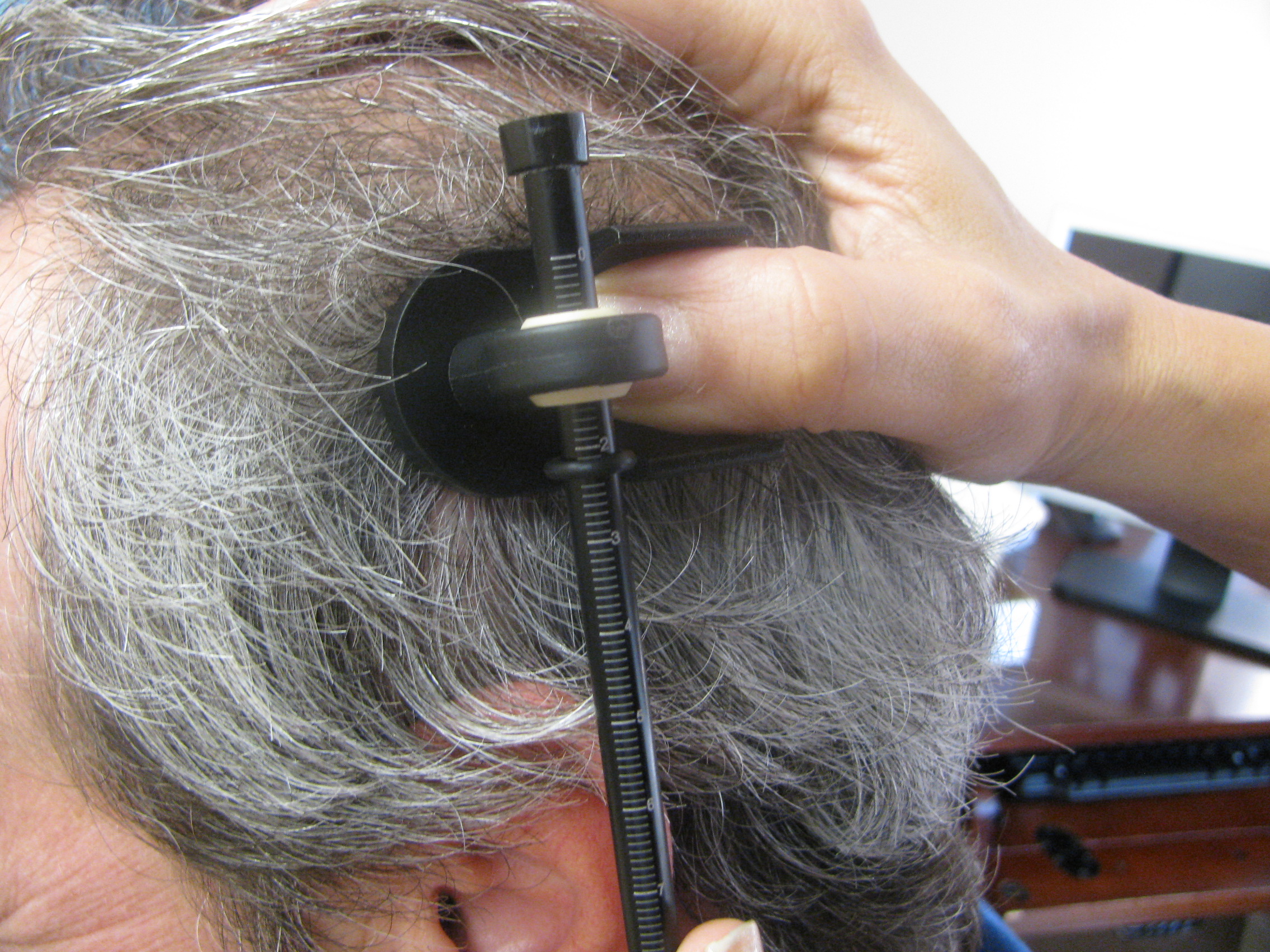 US Hair Transplant» Blog Archive » The Laxometer II being used to