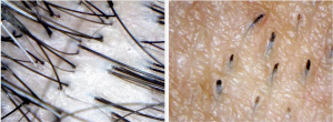 Microscopic View of Scalp hair and Facial Hair