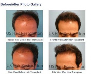 Proven, Permanent, Natural Hair Transplant with Parsa Mohebi, MD