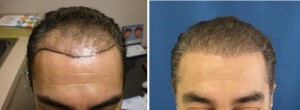 Before & After Successful Hair Restoration
