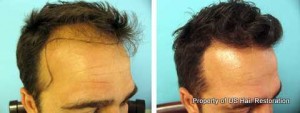 Before & After FUT Results from Mohebi Medical, www.ushairrestoration.com