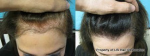 Parsa Mohebi, MD successfully restores female hairline.